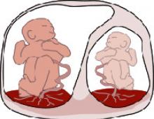 Синдром фето-фетальной трансфузии у близнецов