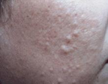 Что такое кальциноз кожи (calcinosis cutis) Воспалительные, особенно аутоиммунные процессы